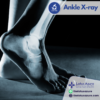 Ankle X-ray (ข้อเท้า)